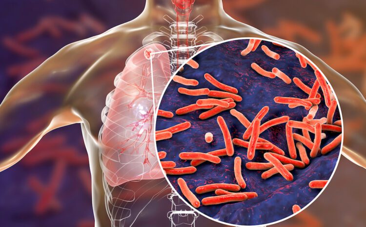 Tuberculosis – Symptoms, Diagnosis & Cure