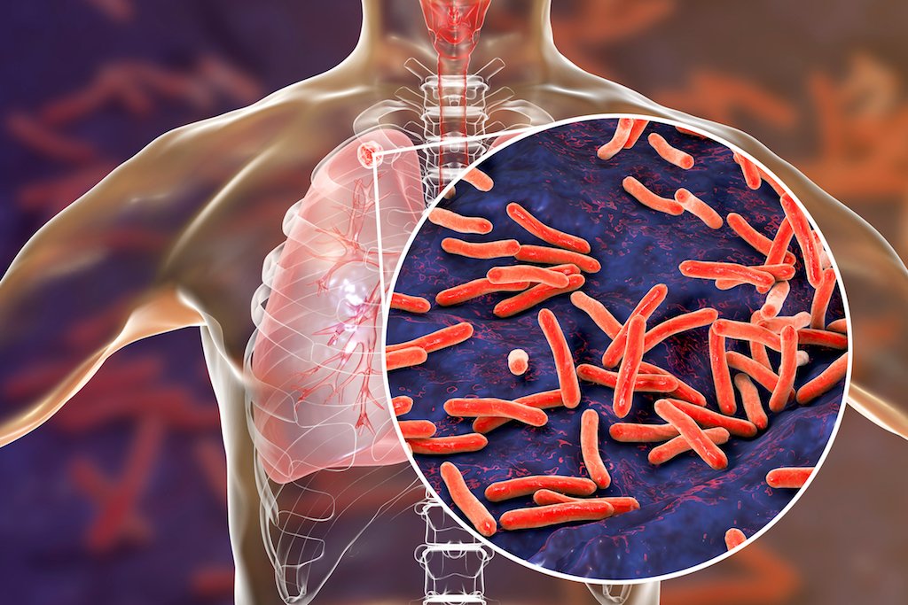 Tuberculosis – Symptoms, Diagnosis & Cure