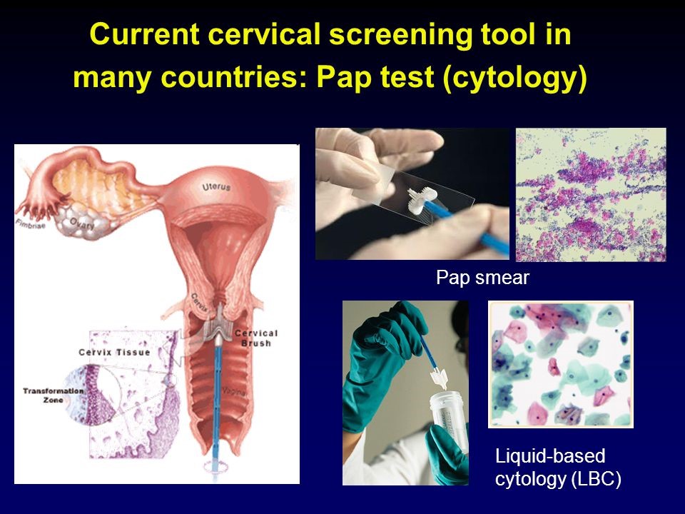 research about cervical cancer